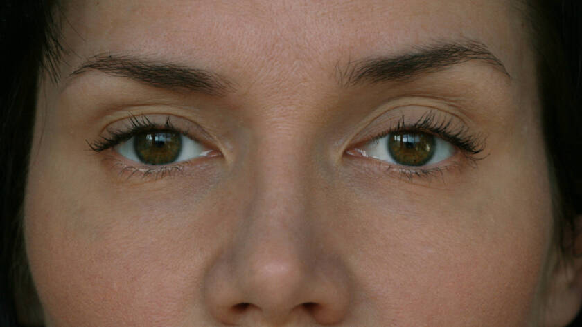 Ptosis Myasthenia Gravis